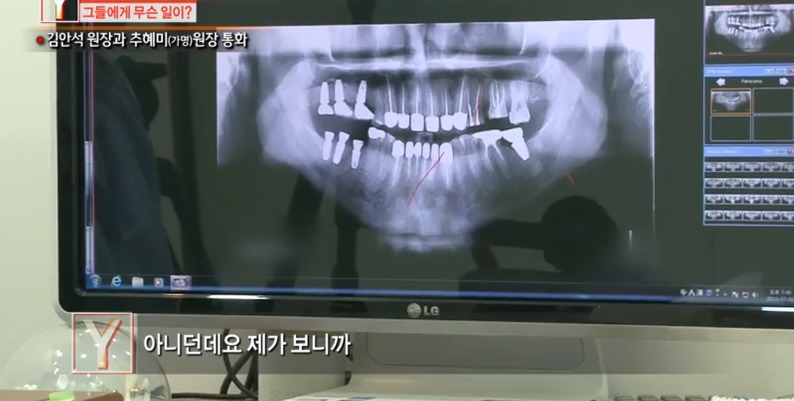 [궁금한이야기] 같은 치과 의사들도 충격받았다는 진료사진.jpg | 인스티즈