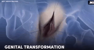 성전환 수술 과정(여-남:FTM)클릭주의 | 인스티즈