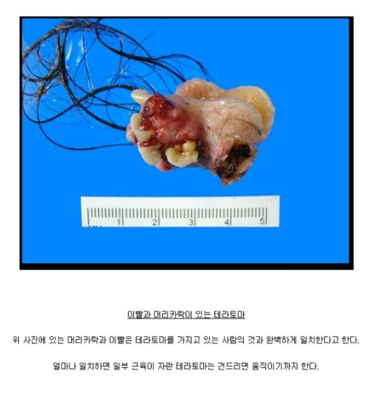 사람을 닮은 기괴한 암 덩어리 테라토마 (혐오주의) | 인스티즈