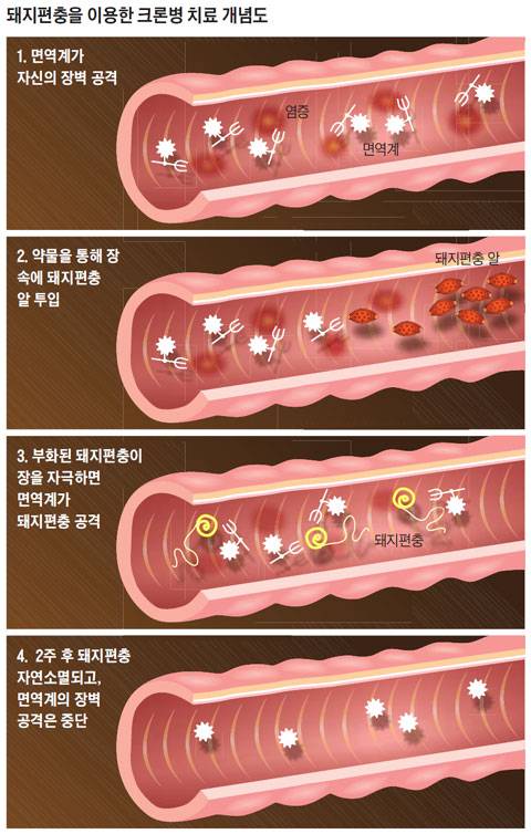 크론병 치료