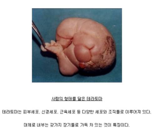 사람을 닮은 기괴한 암 덩어리 테라토마 (혐오주의) | 인스티즈