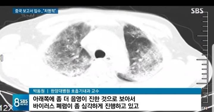 우한 코로나 '치명적 폐 손상' 확인 중국보고서 입수 | 인스티즈