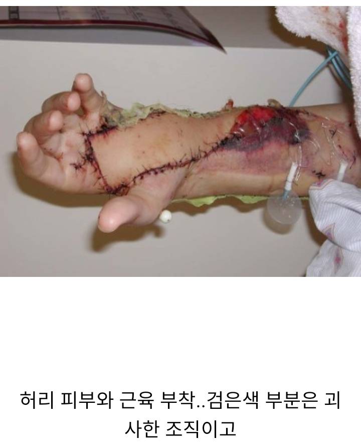 방울뱀한테 물린손 수술 회복과정 (혐오주의) | 인스티즈