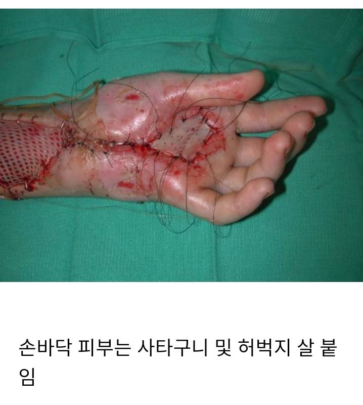 방울뱀한테 물린손 수술 회복과정 (혐오주의) | 인스티즈