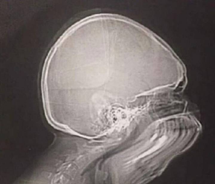 엑스레이 찍다가 재채기 하면 | 인스티즈