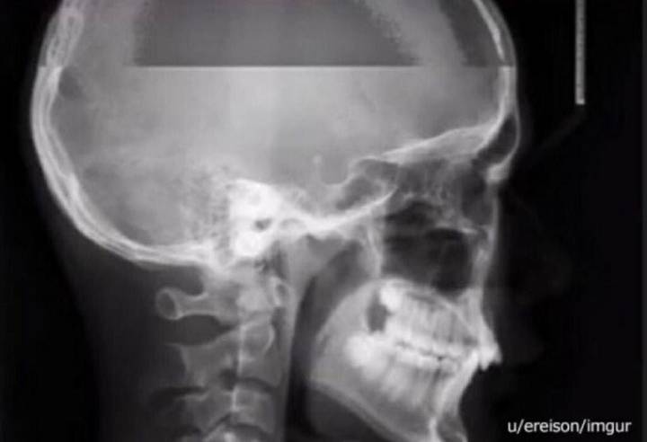 엑스레이 찍다가 재채기 하면 | 인스티즈