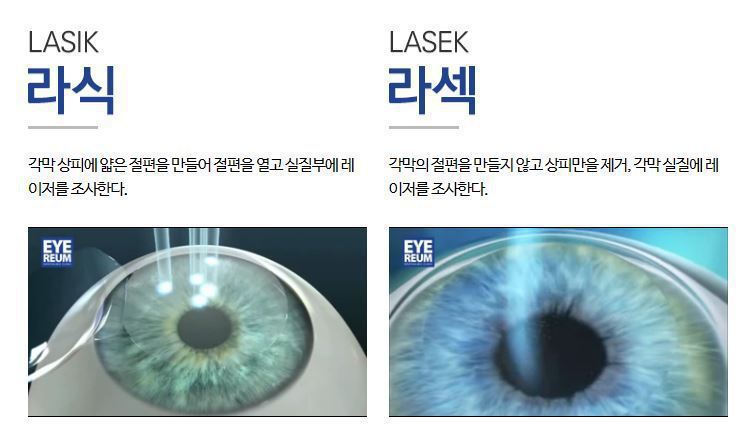 라식,라섹 했던 사람마다 갈리는 것.jp | 인스티즈