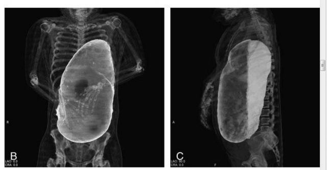 20인분 넘게 먹고 사망한 사람의 X 레이 사진 | 인스티즈