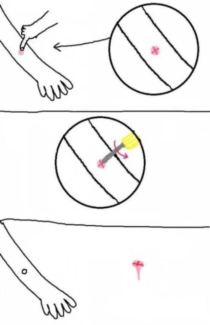 모기물렸을때 대처법 | 인스티즈