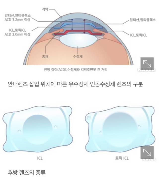 시력 교정 수술중 끝판왕인 렌즈 삽입술 | 인스티즈