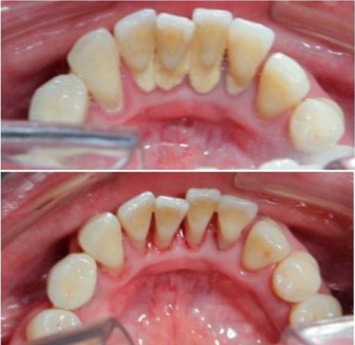 스케일링 너무 이시렵고 아프고 무서운 사람을 위한 극복하는 방법 | 인스티즈