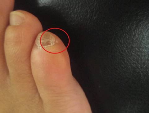 많은 사람들이 가지고 있는 짜증나는 발톱 | 인스티즈