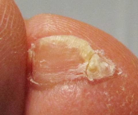 많은 사람들이 가지고 있는 짜증나는 발톱 | 인스티즈