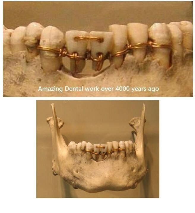 4000년전 이집트의 치아 브릿지 시술 | 인스티즈