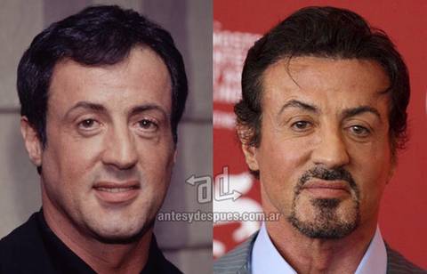 모발이식 성공사례 | 인스티즈