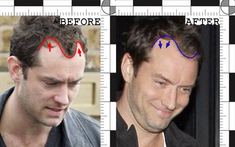 모발이식 성공사례 | 인스티즈