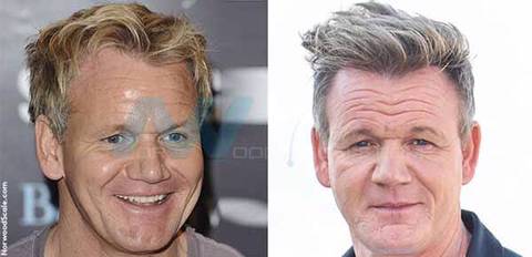 모발이식 성공사례 | 인스티즈