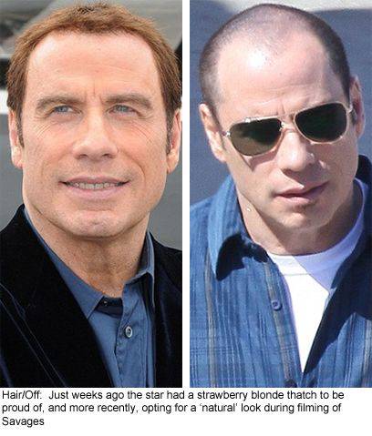 모발이식 성공사례 | 인스티즈