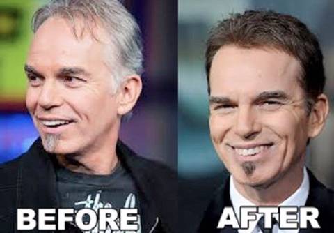 모발이식 성공사례 | 인스티즈