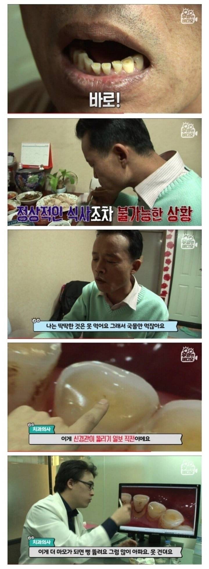 20년간 이갈이한 치아 상태.JPG | 인스티즈