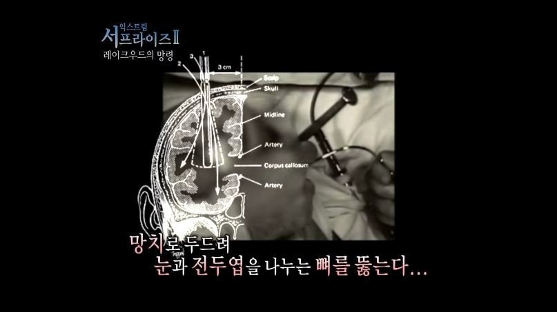 [서프라이즈] 잘못된 수술 레이크우드의 망령.jpg | 인스티즈