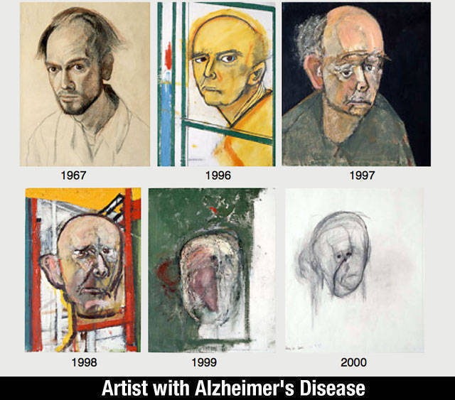 알츠하이머환자가 그린 그림의 변화 | 인스티즈