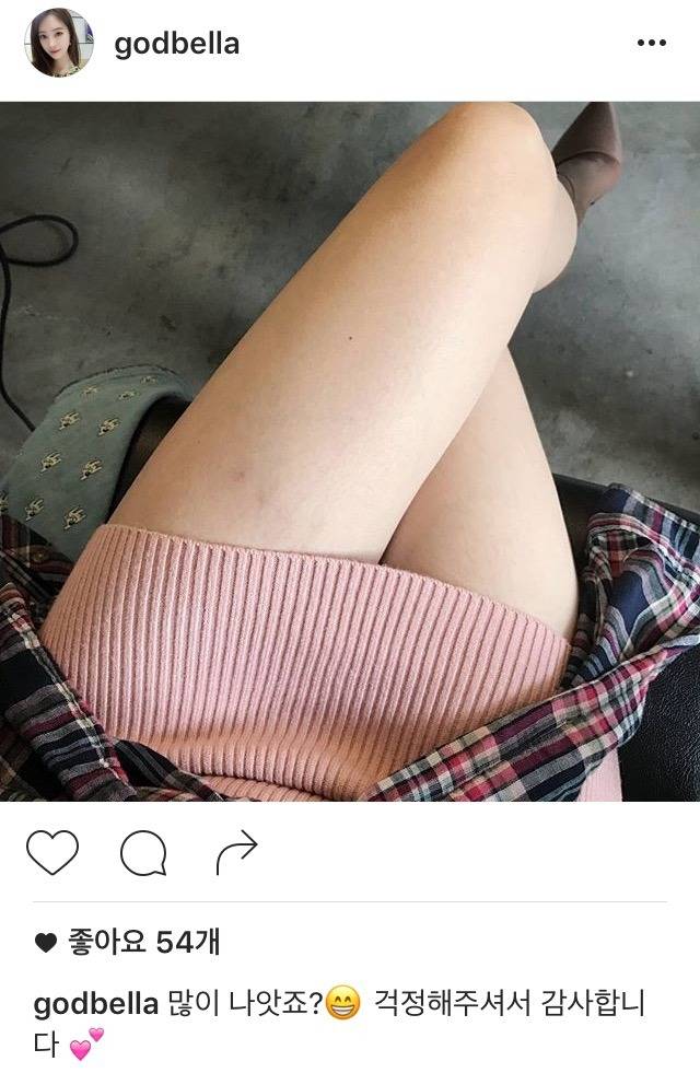 다리미 화상 많이 나은 양정원 | 인스티즈