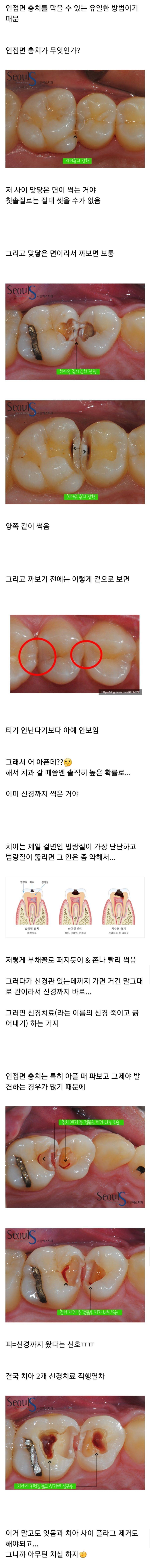 치실이 중요한 이유 | 인스티즈