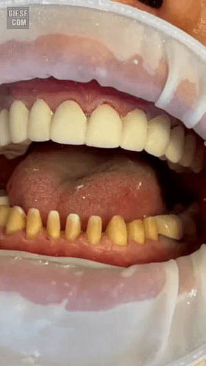 치아 크라운치료 | 인스티즈