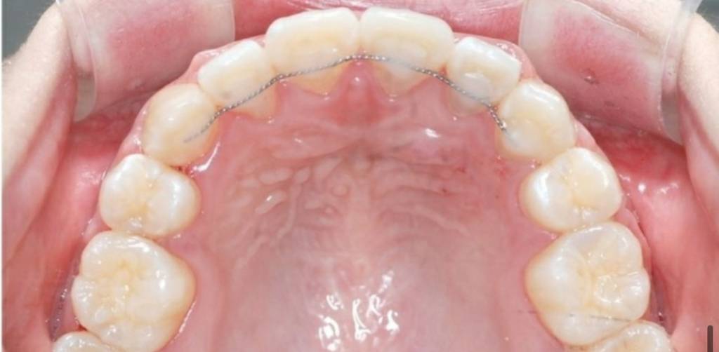 스케일링 꾸준히 해야하는 이유.jpgif | 인스티즈