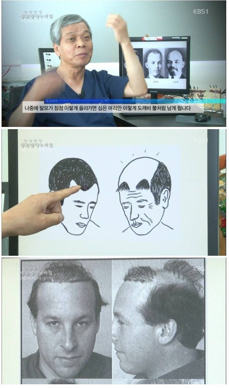 모발이식의 진실.jpg | 인스티즈