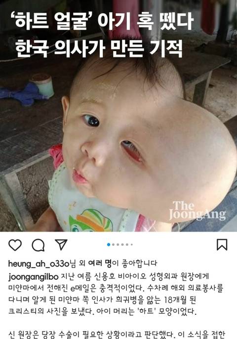 하트 얼굴 아기 혹, 한국 의사가 뗐다 | 인스티즈