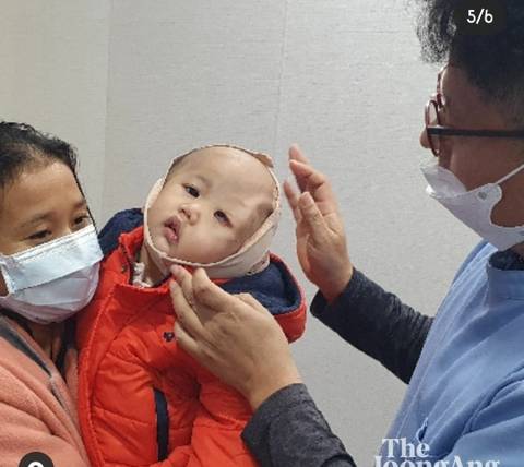하트 얼굴 아기 혹, 한국 의사가 뗐다 | 인스티즈