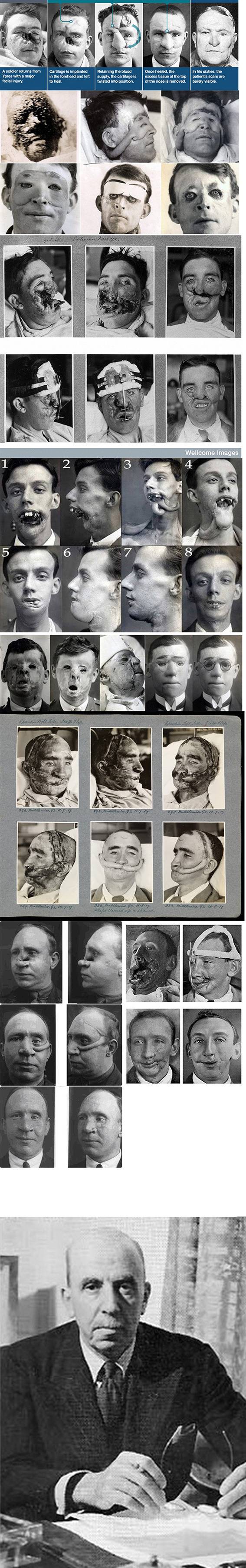 1916 년 재건 성형수술의 수준[사람따라사진주의] | 인스티즈