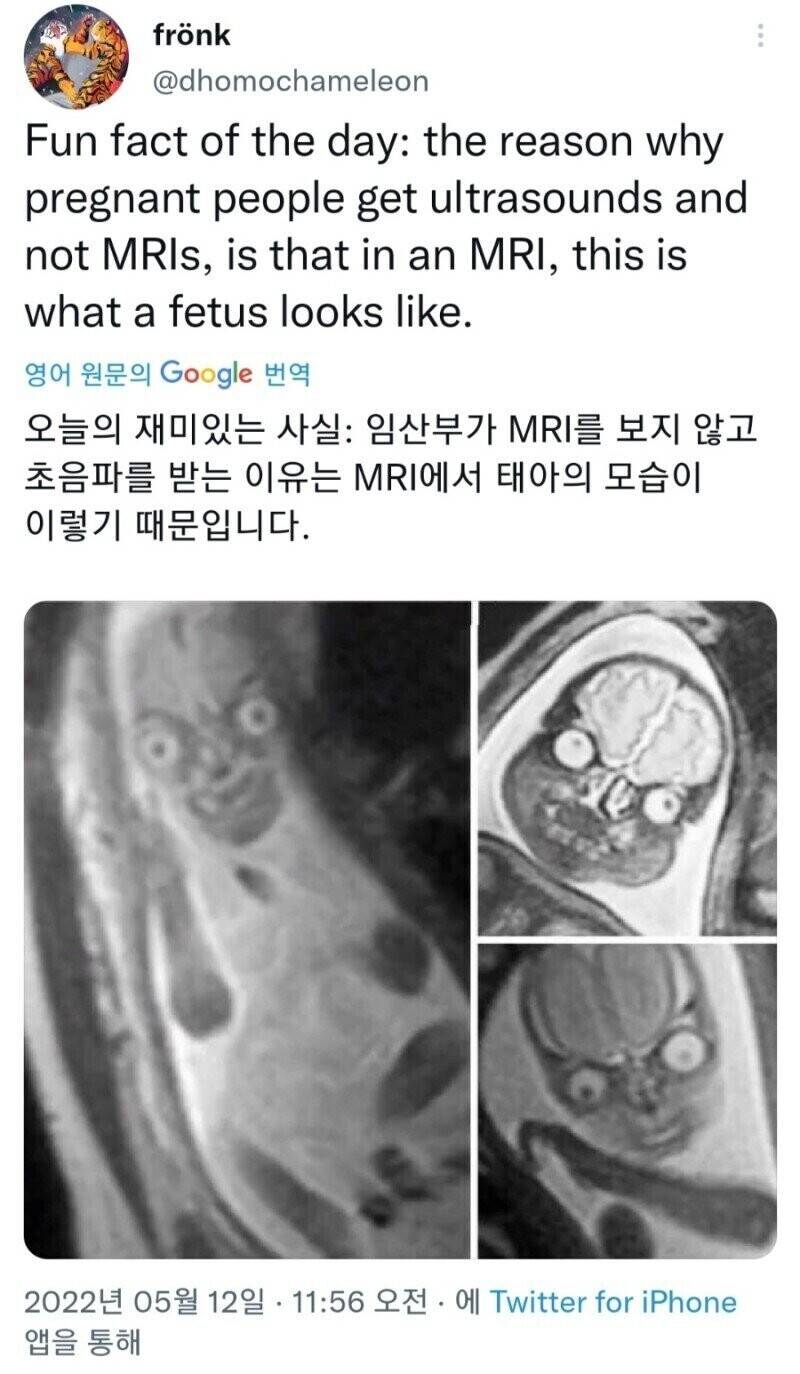 태아 사진을 MRI가 아닌 초음파로 찍는 이유 .jpg | 인스티즈