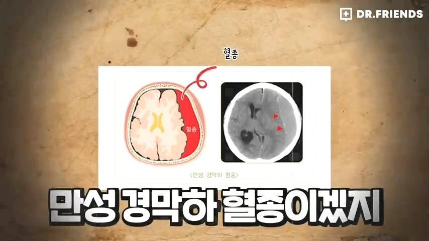 과거 사람들이 두통 생기면 뚝배기부터 열었던 이유 | 인스티즈