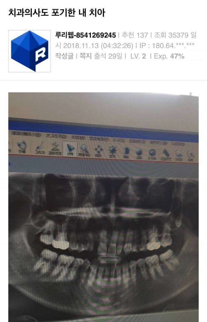 치과의사도 포기한 치아 | 인스티즈