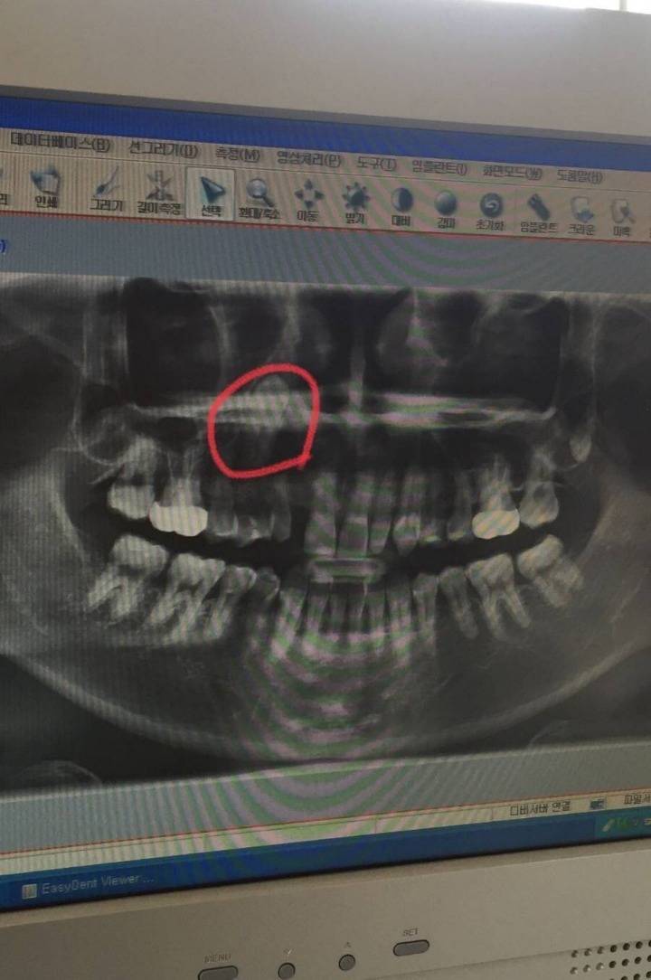 치과의사도 포기한 치아 | 인스티즈