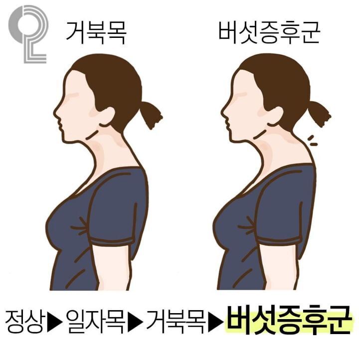 거북목 다음 단계인 버섯증후군.jpg | 인스티즈