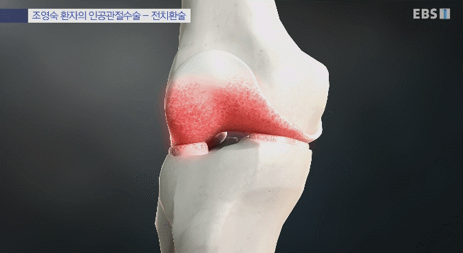 보기만 해도 무서운 무릎 인공관절 수술과정.gif | 인스티즈
