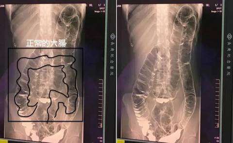 '변비' 때문에 17일 동안 화장실 못 간 여성의 충격적인 엑스레이 사진 | 인스티즈