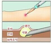 바늘 굵기는 조빱인데 생각보다 개아픈 주사 | 인스티즈