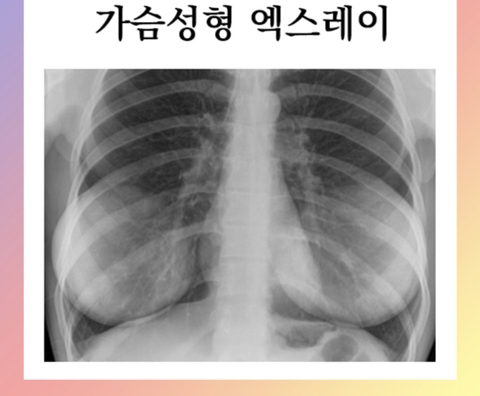 나 드디어 천만원 모아서 모티바로 가슴수술 하려고! | 인스티즈