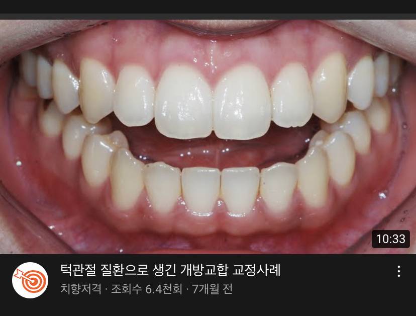 당사자들은 부정교합인지 잘 모르는 부정교합 | 인스티즈