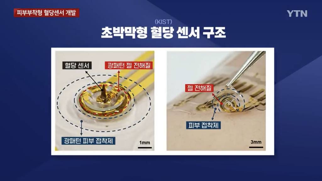 당뇨 환자에 희소식...피부 부착형 혈당 센서 개발 | 인스티즈