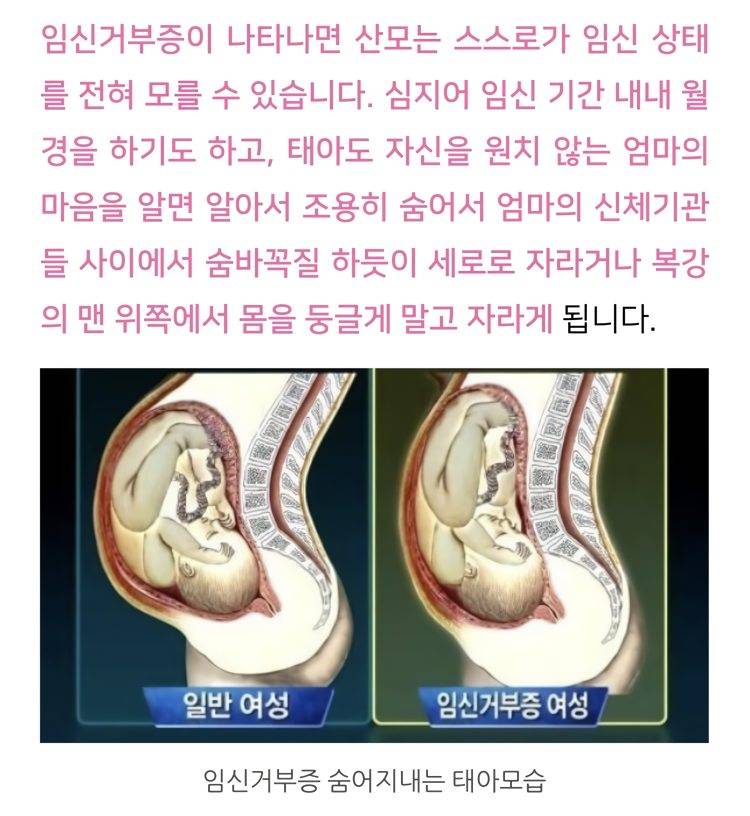 임신거부증의 경우 태아가 숨어있다는거 태아한테 물어봄? | 인스티즈