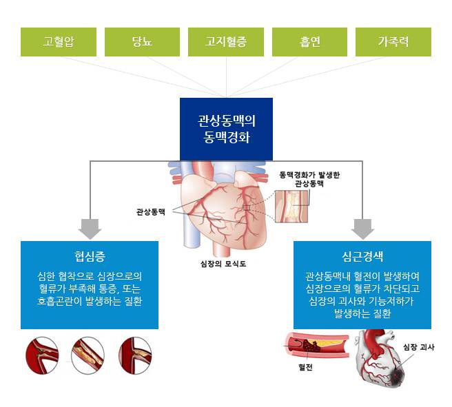 협심증, 심근경색이 위험한 이유... 돌연사 1위 급성심근경색(심혈관질환) | 인스티즈