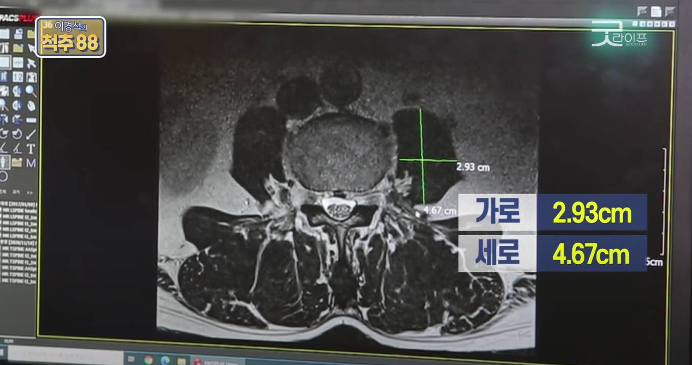 허리디스크 환자에게 코어운동이 중요한 이유(안보면 후회 보장) | 인스티즈