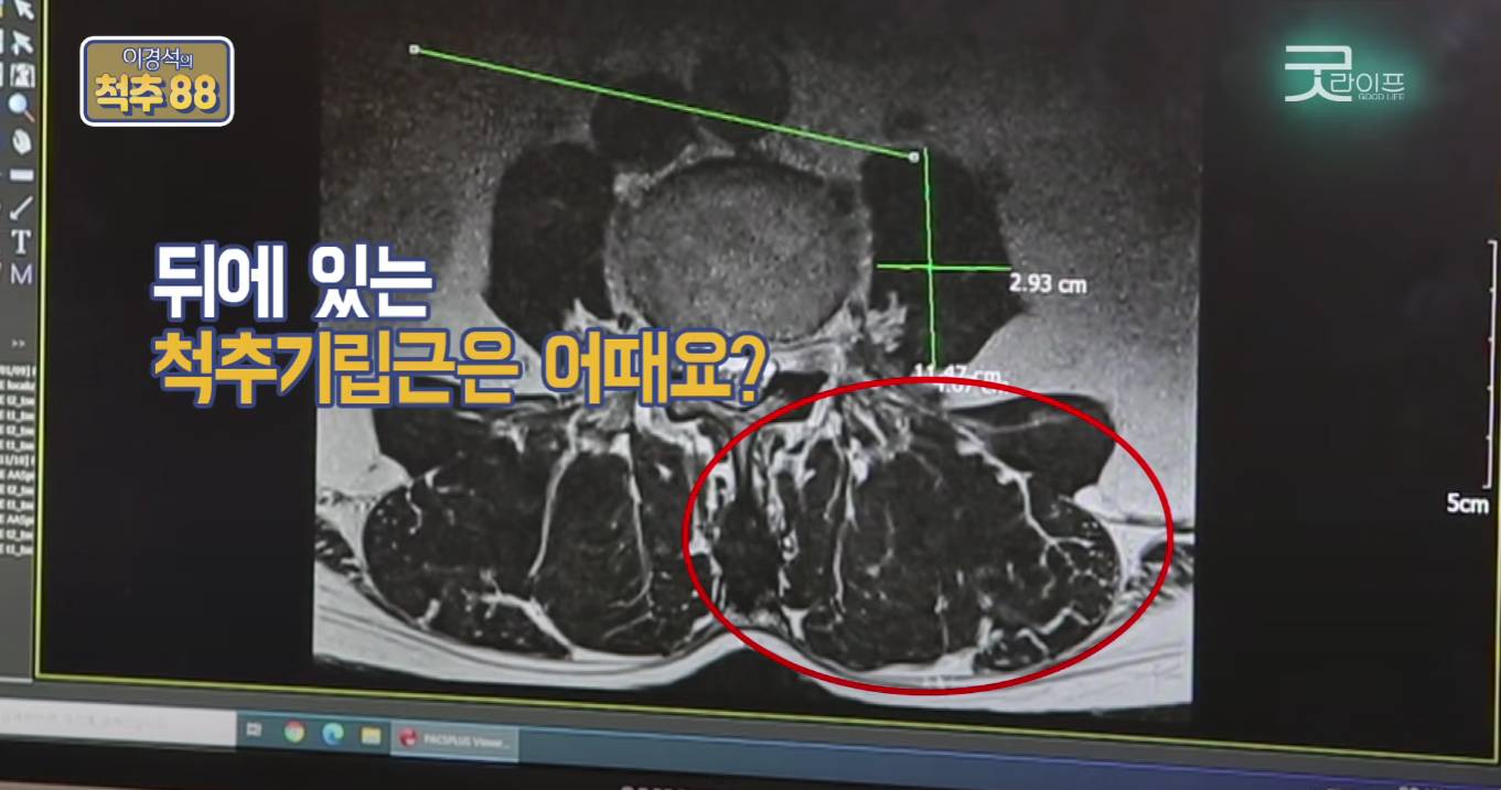 허리디스크 환자에게 코어운동이 중요한 이유(안보면 후회 보장) | 인스티즈