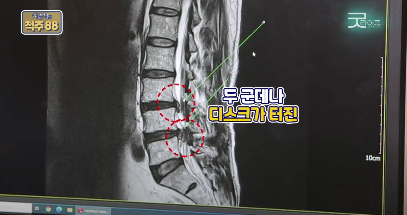 허리디스크 환자에게 코어운동이 중요한 이유(안보면 후회 보장) | 인스티즈